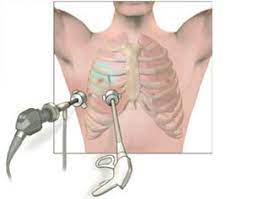 Lung Biopsy Laparoscopyindia Com Laparoscopic And Thoracoscopic Surgery