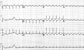 N myocarditis is an inflammatory disease of the heart muscle, diagnosed by established histological n the true incidence of myocarditis is unknown because the majority of cases are asymptomatic. Enterovirus Myocarditis As A Cause Of Neonatal Collapse Adc Fetal Neonatal Edition