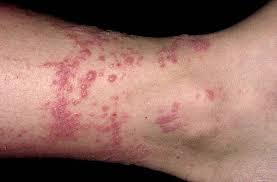 Contact Dermatitis Poison Ivy Rash Poison Ivy Remedies Poison Ivy On Skin