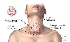 Other possible signs and symptoms which are more common in this type of thyroid cancer include: Goiter Causes Risk Factors Symptoms Diagnosis Treatment