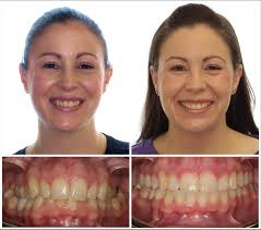 POSTERIOR CROSSBITE refers to the upper teeth in the back being positioned  in the inside of the lower teeth. Usually this is due to the upper jaw  being more narrow than the
