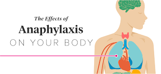 Anaphylaxis is usually caused by a reaction one of the following 15 Effects Of Anaphylaxis On The Body