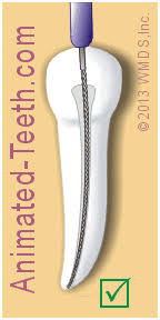 Pain control can be difficult to achieve at times because of anesthetic inactivation by the acidity of the demanding; What To Expect After Root Canal Treatment Post Op Pain Aftercare Precautions