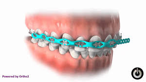 Jenis gigi palsu inilah yang biasa digunakan oleh lansia. Nad S Braces Journey Apa Yang Dilakukan Ketika Monthly Braces Checkups Pengedar Shaklee Kedai Vitamin Bandar Baru Bangi