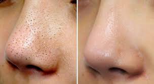 緊急毛穴sp my hit 毛穴の黒ずみ除去 毛穴 顔 毛穴