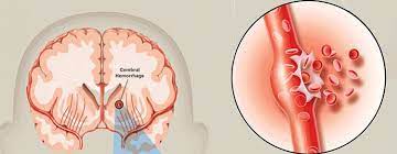 Emorragia cerebrale e ictus emorragico:.dell'ospedale maggiore di bologna dove è stato sottoposto ad intervento chirurgico d'urgenza nella notte tra giovedì e venerdì scorso a seguito di un'emorragia cerebrale scatenata da. L Ictus Che Sanguina Nel Cervello Emorragia Cerebrale Associato All Insorgenza Di Demenza