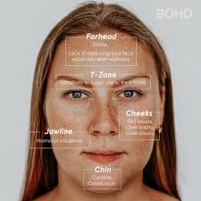 One of the telltale signs of a hormonal breakout is its location on the face. What Kind Of Acne Are You Dealing With Boho Alternative Medical Spa