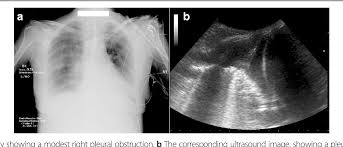 Detection of pleural effusion(s) and the creation of an initial differential diagnosis are highly dependent upon imaging of the pleural space. Figure 1 From Thoracic Ultrasound For Pleural Effusion In The Intensive Care Unit A Narrative Review From Diagnosis To Treatment Semantic Scholar