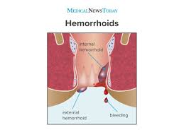 Generally speaking, hemorrhoids are not a serious medical condition. Hemorrhoids During Pregnancy Symptoms Treatment And More