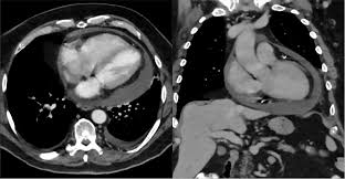 Mediastinum or the chest wall (fig. Pericardial Effusion Pacs Suche Fur Radiologen