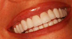 Empress Dis Modelleri Yapimi Ve Empress Porselen Fiyatlari Dentvital