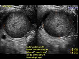 In premenopausal women, fewer than 1% of new growths on or in an ovary will turn out to be cancer. Hemorrhagic Ovarian Cysts One Entity With Many Appearances Mdedge Obgyn