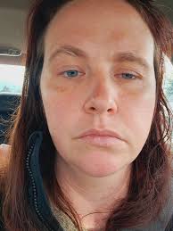 I'm experiencing minimal NF-related side effects