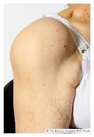 An irregular shallow cavity in the scapula called the glenoid cavity forms the socket for the head of the humerus to fit in. Milwaukee Shoulder Syndrome