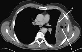 Subpulmonic effusions (also known as subpulmonary effusions) are pleural effusions that can be seen only on an erect projection. Investigation Of A Unilateral Pleural Effusion In Adults British Thoracic Society Pleural Disease Guideline 2010 Thorax
