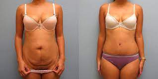 There are many issues you needed to keep in mind when deciding if this would be the right treatment for you—including concerns about the recovery period and scars. Tummy Tuck Corpus Christi Dr Vijay Bindingnavele