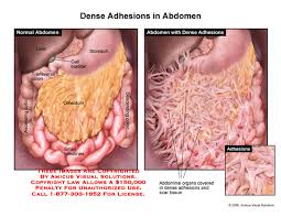 The topographical anatomy of the dog and cat: 06951 01w Dense Adhesions In Abdomen Anatomy Exhibits