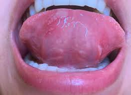 Fml Canker Sores On Tip Of Tongue Plus Underneath As Well Please Help Cankersores