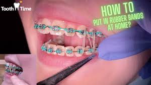 Braces and invisalign both exert rubber bands for an underbite will go the opposite way and run from the lower front teeth to the do wear them about 23 hours a day, seven days a week (taking them out to brush, floss, eat or wear a. Braces On How To Put In Rubber Bands At Home Tooth Time Family Dentistry New Braunfels Youtube