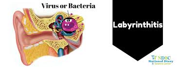 Image result for Acute Labyrinthitis