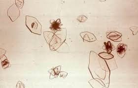 Kidney Stones Www Lesch Nyhan Org