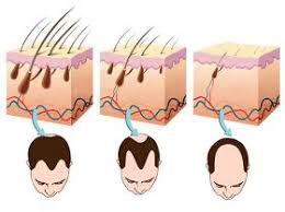 This type of hair loss hair loss: Dr Virginia Benitez Roig Aesthetic Treatments Marbella Spain 6 Foods You Should Eat To Reverse Ha Reverse Hair Loss Mens Hair Loss Remedies Hair Loss Remedies
