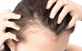 Come indica il nome, nella domanda di trapianto di capelli non rasati, l'operazione viene eseguita senza radersi o accorciare i capelli. Trapianto Capelli Donne Fue Rasatura Tempi E Costi