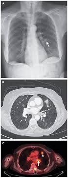 Ct scan showing a cancerous tumor in the left lung. Case 30 2019 A 65 Year Old Woman With Lung Cancer And Chest Pain Nejm