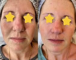 Zastrzyk Piękna Daria Pawłowska