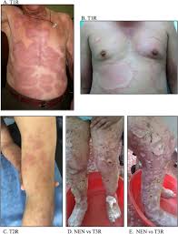 Image result for Leprosy