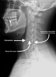 The procedure for a locked facet joint is relatively simple. Facet Joint Syndrome Physiopedia