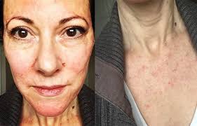 I Tried The Blood Plasma Facial — Here's What Happened"