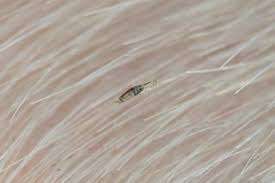 White people get head lice more often than other racial groups. Head Lice And Nits Nhs