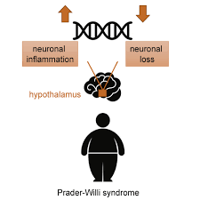 Official facebook page for williams racing. A Transcriptomic Signature Of The Hypothalamic Response To Fasting And Bdnf Deficiency In Prader Willi Syndrome Cell Reports