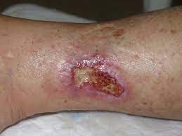 The current review aims to summarize the current evidence on martorell hytilu and provide recommendations on its management.keywords: Key Elements To Understanding Martorell Ulcer Elena Conde Montero