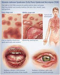 < 10% of body surface area. Episode 162 0 Stevens Johnson Syndrome Toxic Epidermal Necrolysis Core Em