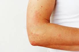 Image result for Photodermatitis