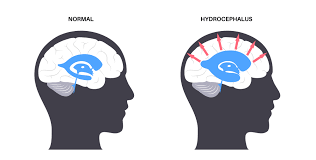 Image result for Hydrocephalus