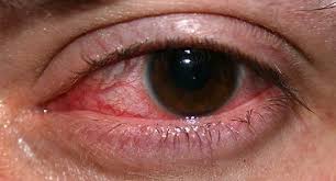 Image result for lesion sclera