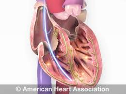 Cardiac problems are the leading cause of death worldwide. Implantable Cardioverter Defibrillator Icd American Heart Association