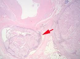 The renal artery divides into the segmental arteries within the renal sinus. B Carcinoma Within Vascular Channels Within The Renal Sinus Download Scientific Diagram