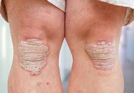 2 causes of ra 2 diagnosing ra 3 ra by the numbers 3 coping with ra symptoms 4. If You Have Psoriasis Watch For Early Signs Of Psoriatic Arthritis Health Essentials From Cleveland Clinic
