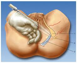 Image result for Active Labor Anesthesia