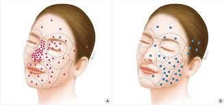 The strongest risk factor for developing skin cancer is ultraviolet (uv) ray exposure, typically from the sun. Distribution Of Basal Cell Carcinoma On Facial Esthetic Units A The Download Scientific Diagram