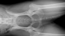 Legg Calve Perthes Disease In Dogs
