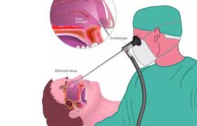 Image result for Intubation Associated Sinusitis