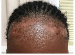 In mild cases, your head may feel itchy and you may notice fine flakes of. Seborrheic Dermatitis Seborrheic Dermatitis Associated With Scaly Download Scientific Diagram
