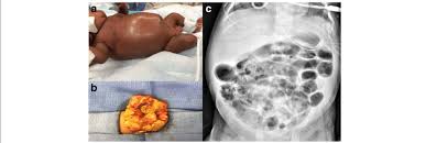 Image result for Necrotizing Enterocolitis