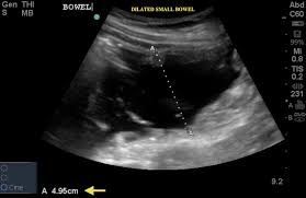 Image result for Intussusception
