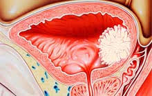 The bladder is a hollow organ in the pelvis with flexible. Bladder Cancer